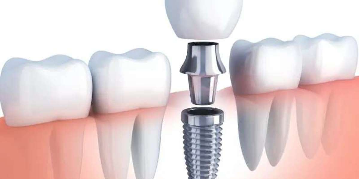 Comprehensive Guide to Dental Implants: Procedure, Benefits, and Considerations
