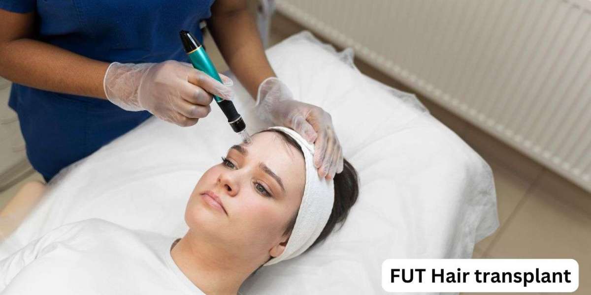 The  FUT Hair Transplant Revolution: How to Transform Your Look